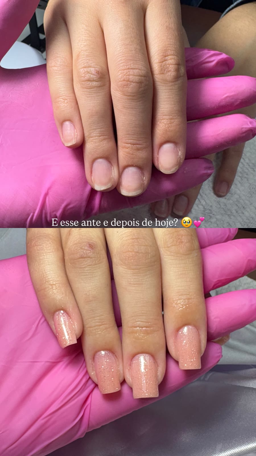 Antes e depois: Alongamento nude com brilho — Ana Corrêa